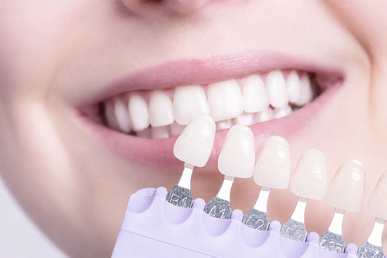 Composite bonding and cosmetic smile enhancement