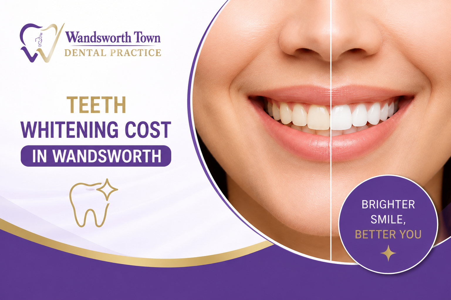 Teeth Whitening Cost Wandsworth
