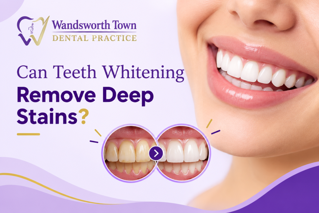 Can teeth whitening remove deep stains